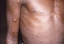 डब्ल्यूएचओ ने कोरोना और मंकीपॉक्स को बताया दुनिया की सबसे बड़ी चुनौती