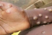 11 देशों में मिले मंकीपाक्स के मामले