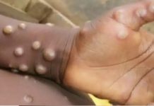 उत्तराखंड में मंकीपॉक्स वायरस को लेकर अलर्ट जारी, स्वास्थ्य विभाग ने जारी किए नए निर्देश