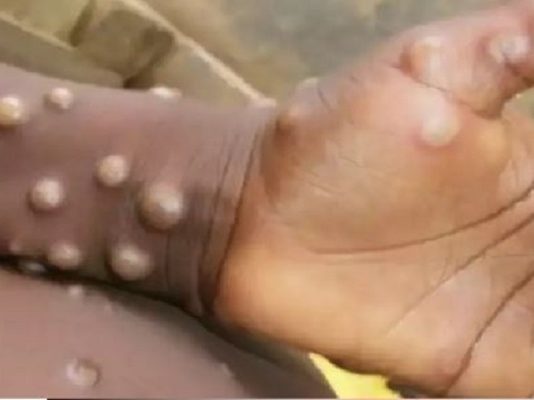 उत्तराखंड में मंकीपॉक्स वायरस को लेकर अलर्ट जारी, स्वास्थ्य विभाग ने जारी किए नए निर्देश