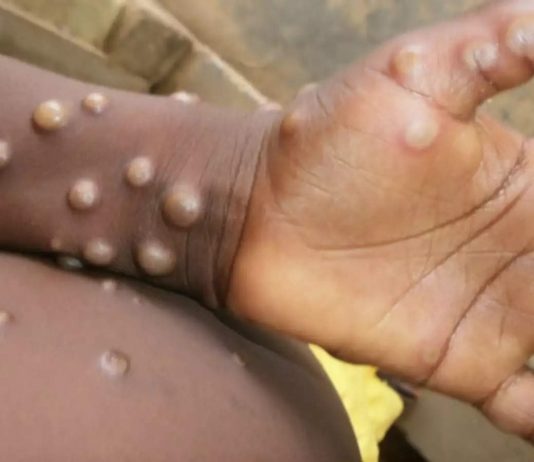 मंकीपॉक्स को शुरुआती चरण में रोकने के लिए हर संभव प्रयास करना जरुरी: डब्ल्यूएचओ