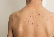 दिल्ली में मंकीपॉक्स के पहले मरीज की हुई पुष्टि, मौलाना आजाद मेडिकल कॉलेज में किया भर्ती