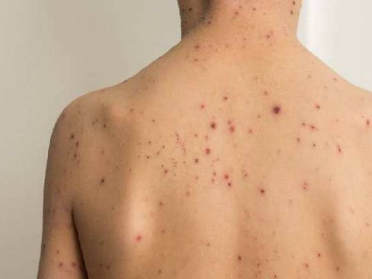 दिल्ली में मंकीपॉक्स के पहले मरीज की हुई पुष्टि, मौलाना आजाद मेडिकल कॉलेज में किया भर्ती