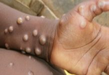 यूपी में मंकी पॉक्स अलर्ट जारी, हवाई अड्डों और रेलवे स्टेशनों पर की जारी निगरानी