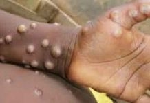 मंकीपॉक्स को लेकर सतर्क हुआ स्वास्थ्य विभाग, जारी किए निर्देश