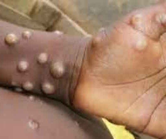 मंकीपॉक्स को लेकर सतर्क हुआ स्वास्थ्य विभाग, जारी किए निर्देश