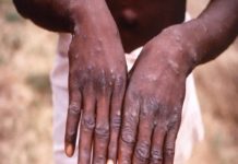 मंकीपॉक्स से हुई व्यक्ति की मौत से स्वास्थ्य महकमे पर मचा हड़कंप