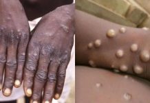 अब कम हो रहे मंकीपॉक्स के मामले, डब्लूएचओ ने दी जानकारी
