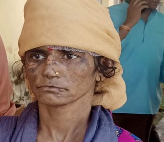 सास और ननद ने क्रूरता से महिला को गर्म तवे से जलाया, विरोध करने पर बच्चों से की मारपीट