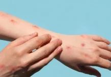 दुनियाभर में मंकीपॉक्स के मामले 70 हजार के पार, डब्ल्यूएचओ ने दी चेतावनी